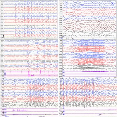 Pediatric epilepsy surgery in patients with Lennox-Gastaut syndrome after viral encephalitis